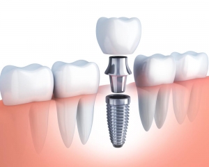 Signs You Need to Replace a Dental Implant Crown Signs You Need to Replace a Dental Implant Crown