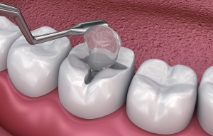 Tooth Filling Fell Out: Here's How to Handle It Tooth Filling Fell Out: Here's How to Handle It